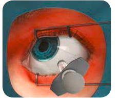 Eylea HCP